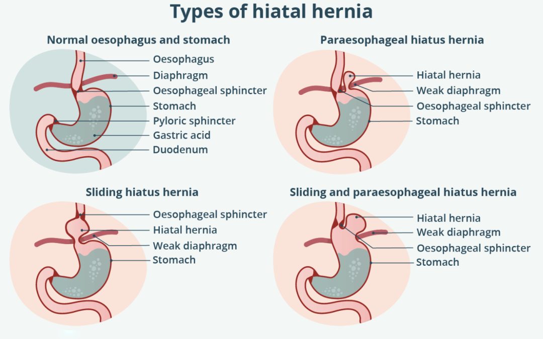 Understanding Heartburn and GERD